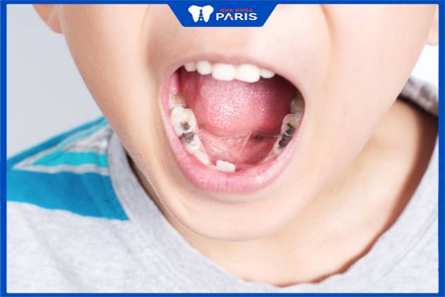 Sâu răng ở trẻ em là bệnh lý phổ biến do thói quen ăn uống nhiều đường và tinh bột