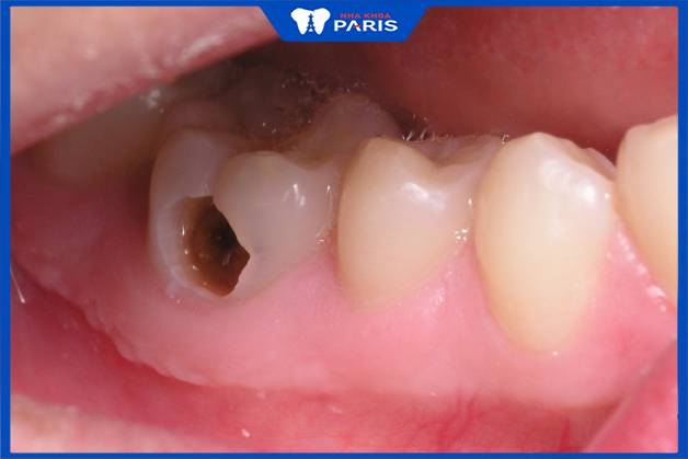 Sâu răng hàm ảnh hưởng đến chức năng nhai