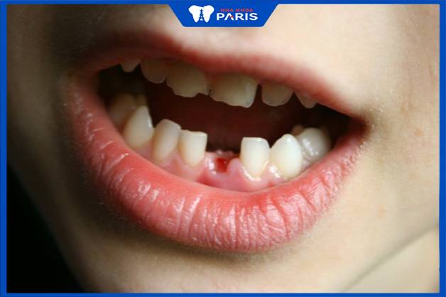 Sâu răng có thể dẫn đến mất răng