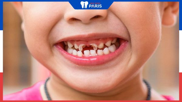 Sâu răng ở trẻ em: Nguyên nhân và cách điều trị dứt điểm