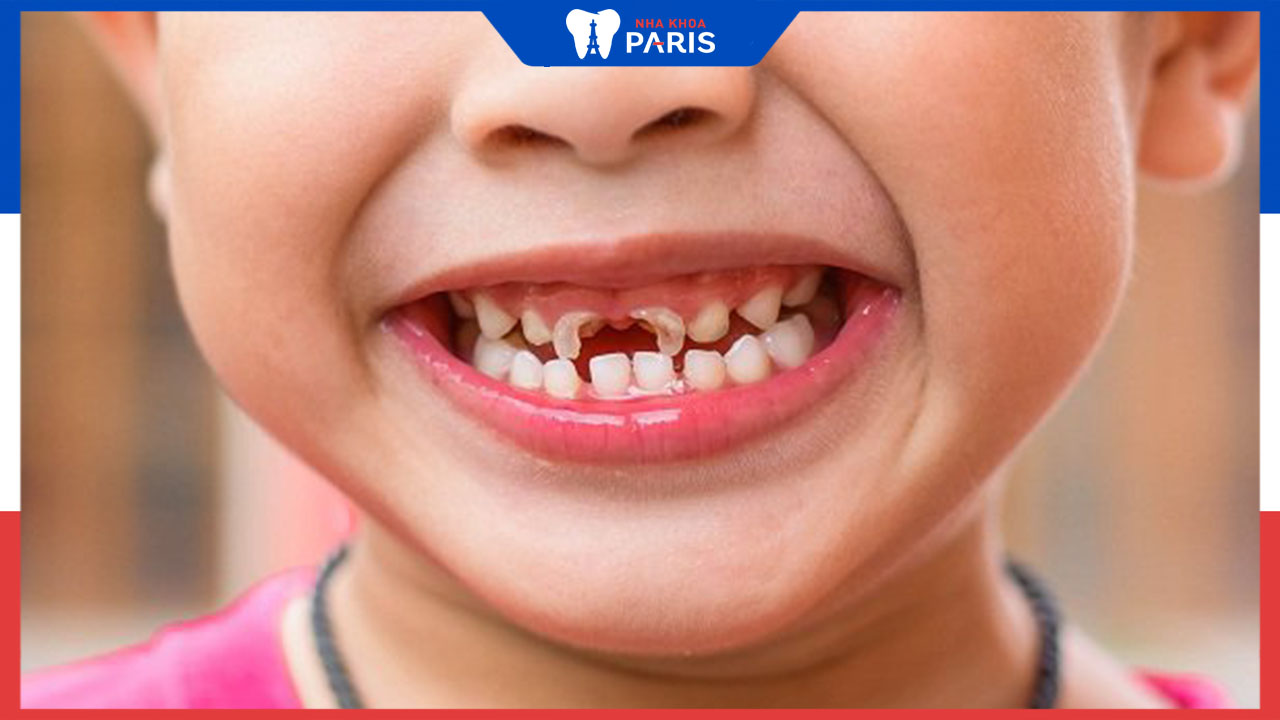 Sâu răng ở trẻ em: Nguyên nhân, dấu hiệu, cách phòng và điều trị triệt để