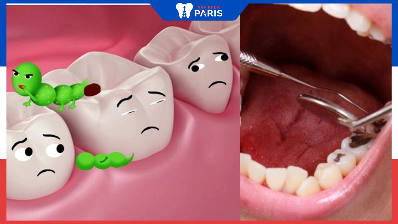 Sâu răng là gì? 4 cách điều trị răng sâu bị thủng lỗ phổ biến