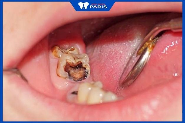 Bọc răng sứ có nguy cơ xâm hại tới tủy răng