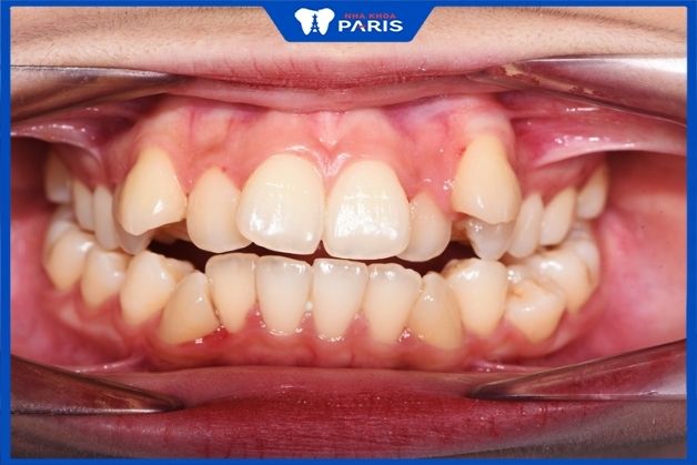 Niềng răng một hàm bao nhiêu tiền dựa vào mức độ răng mọc lệch