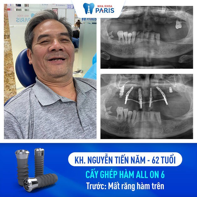 Chú Nguyễn Tiến NĂm cấy ghép implant cả hàm tại nha khoa Paris