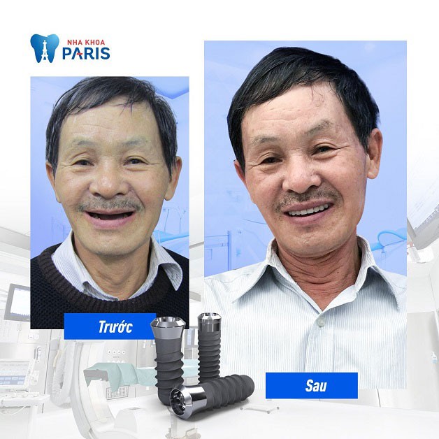 Trồng implant cả hàm tại nha khoa Paris