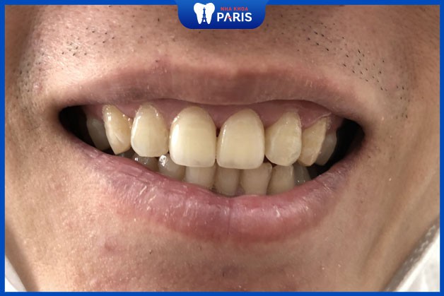 Răng sứ 4S thuộc top độ bền trên thế giới