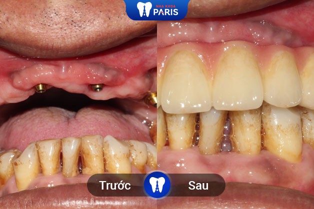 trồng răng Implant All On