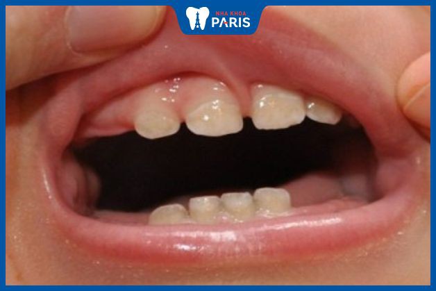 Trẻ mọc răng hàm có thể mất vài tháng.