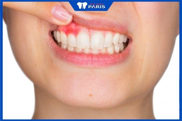 Mối liên hệ giữa đái tháo đường và bệnh răng miệng