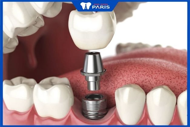 Quy trình phục hình răng Implant cho người bị tiểu đường
