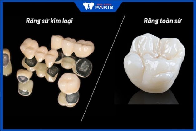 Mỗi loại răng sứ có một giá thành khác nhau