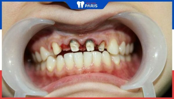 Bọc răng sứ bị ê buốt: Nguyên nhân và cách khắc phục hiệu quả