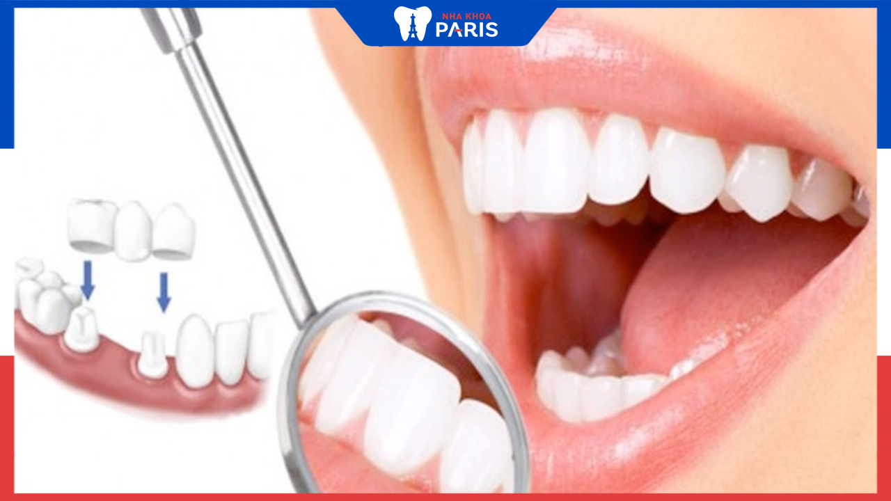 Bọc răng sứ có đau không? Giải đáp từ bác sĩ paris
