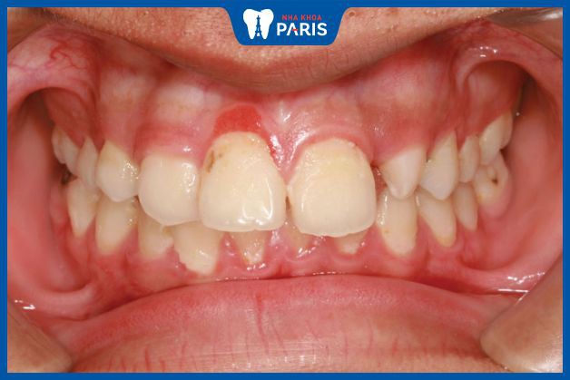 Bệnh lý viêm lợi cần được điều trị triệt để trước khi bọc răng sứ