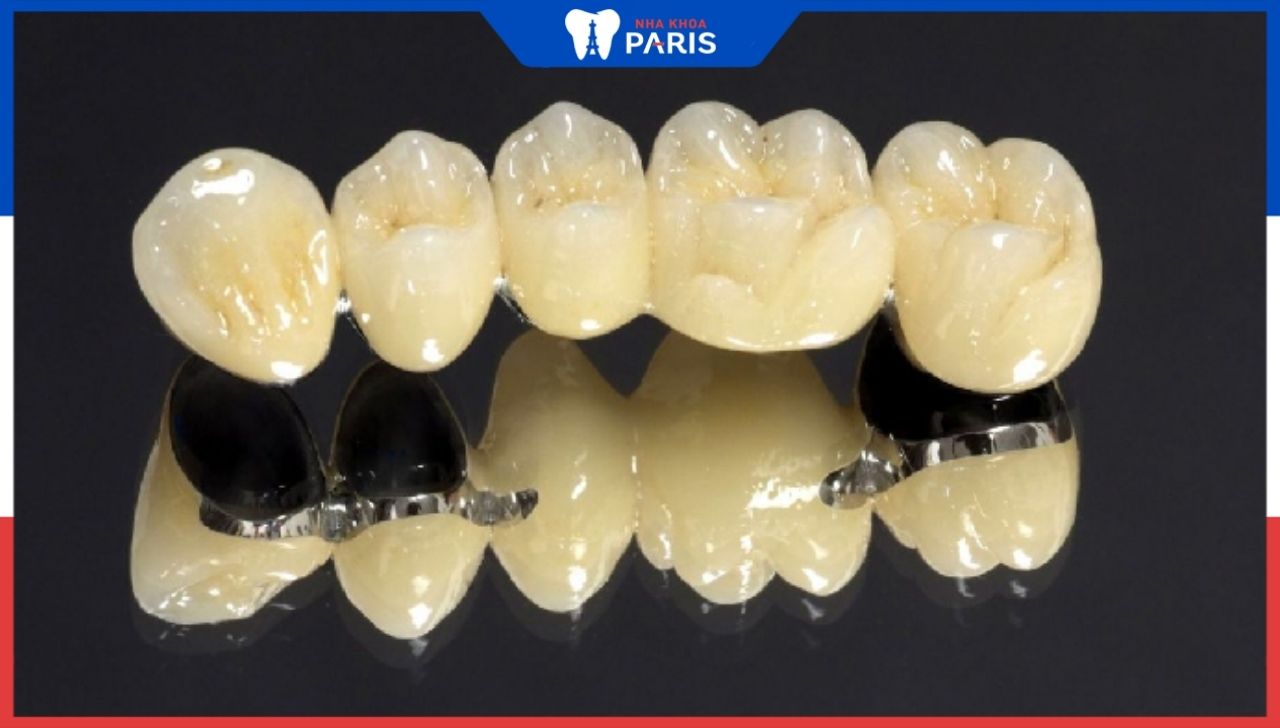 Bọc răng sứ titan: ưu/nhược điểm và tuổi thọ trung bình