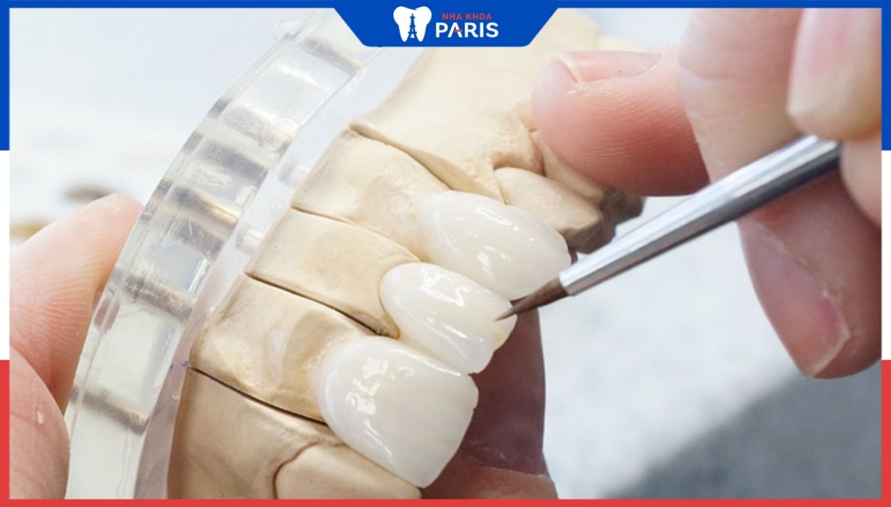 Bọc răng sứ toàn hàm giá bao nhiêu? Khi nào cần bọc răng cả hàm?