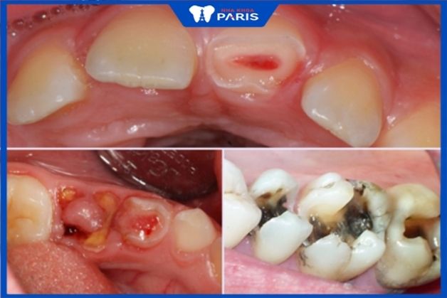 Bọc răng sứ toàn hàm với răng sứt mẻ, sâu răng ăn mòn