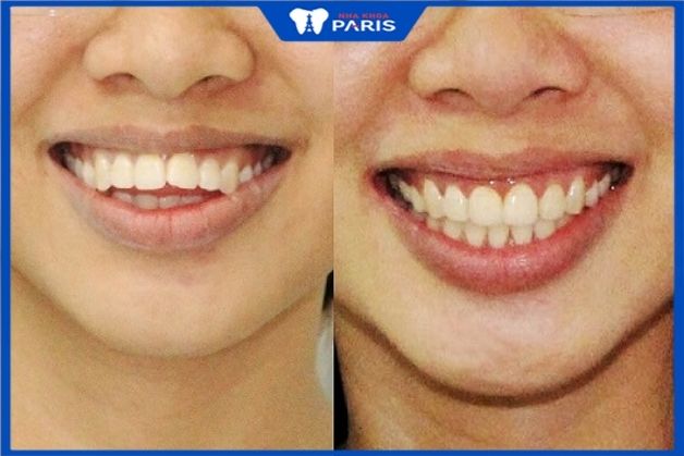 Răng sứ cải thiện khả năng ăn nhai rất tốt