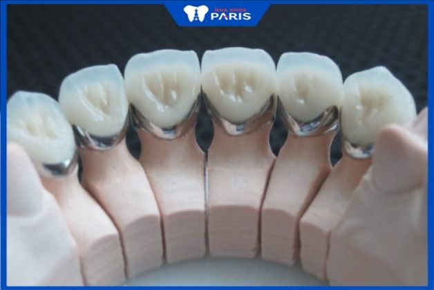 Răng sứ titan là loại răng được nhiều khách hàng lựa chọn