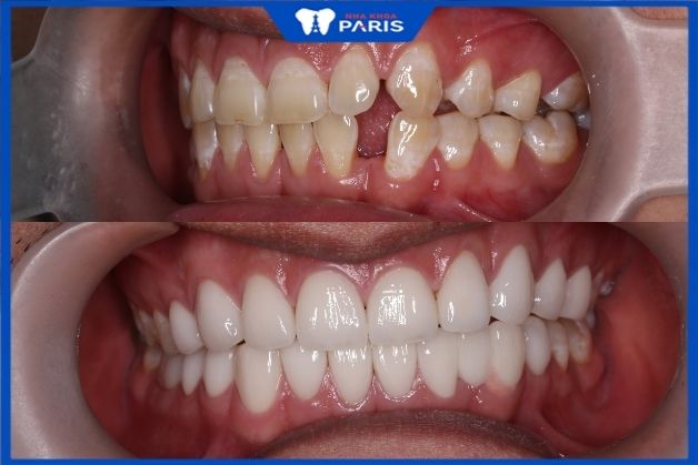 Khách hàng Nguyễn Cản Cường bọc răng sứ veneer tại Nha khoa Paris