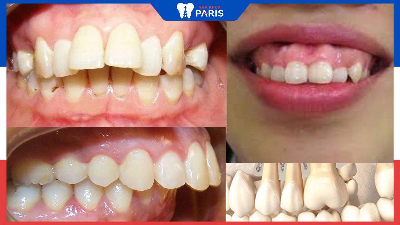 Cách nhận biết răng hô chuẩn xác và phương pháp điều trị triệt để