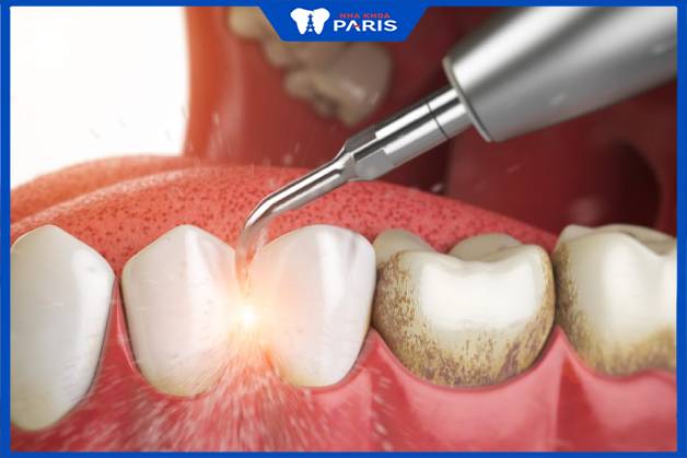 Cạo vôi răng có ảnh hưởng gì không, có đau không phụ thuộc vào tay nghề bác sĩ
