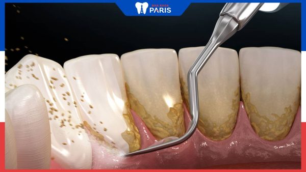 Hỏi đáp: Cạo vôi răng có ảnh hưởng gì không?