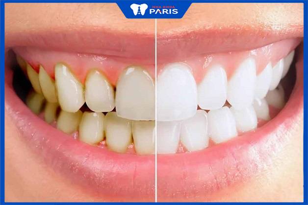Hình ảnh trước và sau khi lấy cao răng