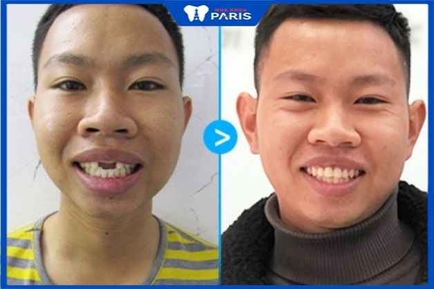 Anh Hoàng - trồng 2 răng cửa implant