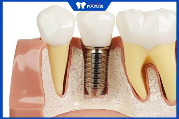 Trồng implant là kỹ thuật phục hình răng bị mất hiệu quả