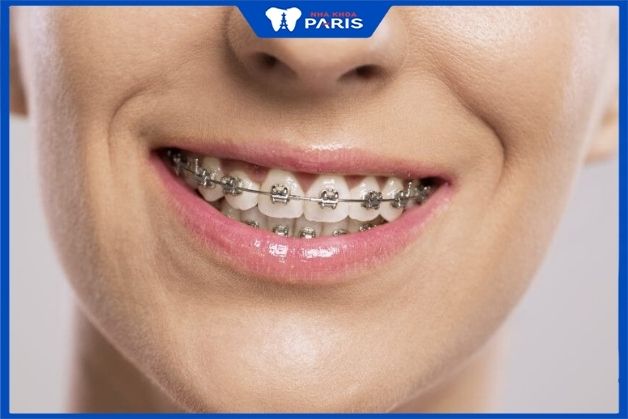 Giái đáp: Chi phí niềng răng mắc cài kim loại bao nhiêu?