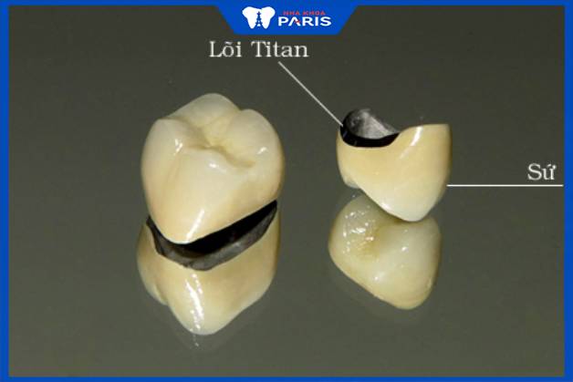 Răng sứ titan thuộc dòng răng sứ kim loại nhưng cao cấp hơn