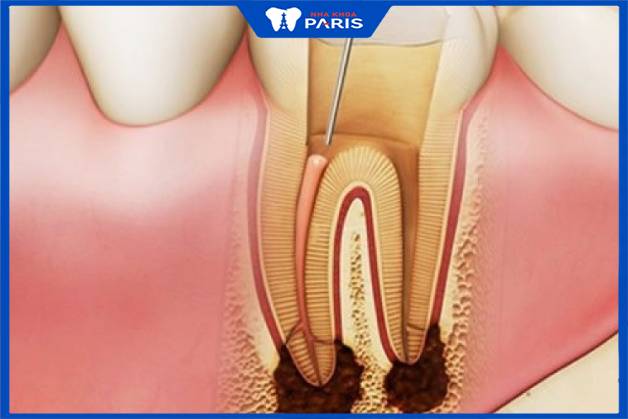 Răng đã điều trị tủy răng dễ vỡ 