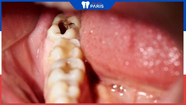 Nhổ răng khôn số 8, những lưu ý quan trọng? Bác sĩ nha khoa giải đáp