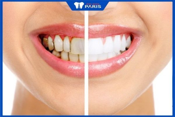 Công nghệ tẩy trắng răng laser chính gốc hiệu quả, an toàn