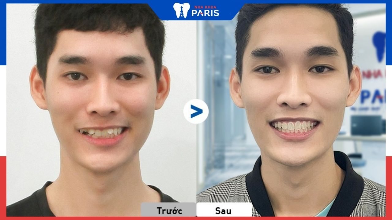 Bật mí địa chỉ niềng răng uy tín ở Hà Nội: có thể bạn chưa biết
