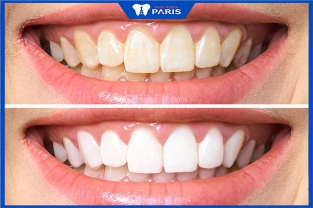 Trước và sau tẩy trắng răng