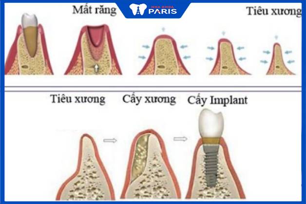 Ghép xương răng đảm bảo trụ implant đứng vững trên cung hàm