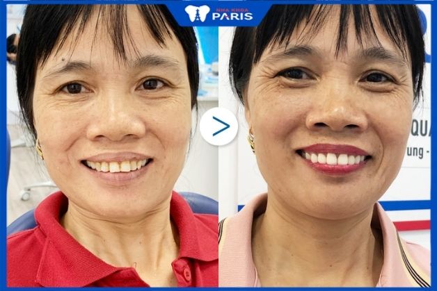 Khách hàng trước và sau bọc răng sứ tại nha khoa Paris