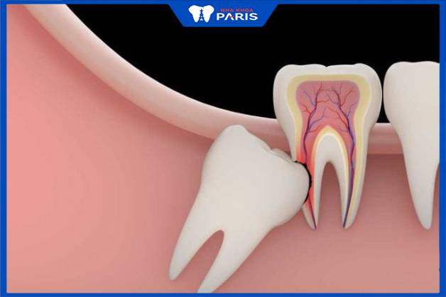 Nhổ răng khôn mọc ngầm thực hiện khó và phức tạp hơn các trường hợp khác 