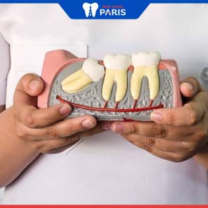 Nhổ răng khôn bao nhiêu tiền? Các yếu tố ảnh hưởng tới chi phí
