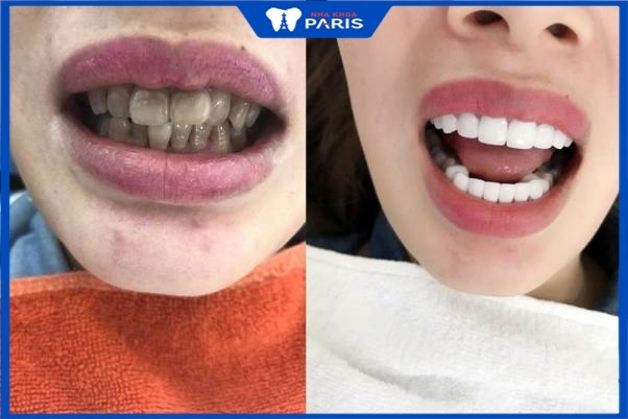 Trước và sau bọc răng sứ