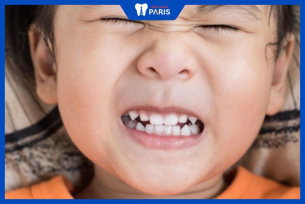 Nghiến răng nhiều tăng khả năng đau răng sứ