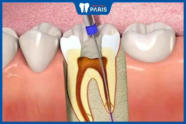Răng có nhiều chân cần nhiều thời gian điều trị tủy hơn