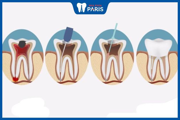 Lấy tủy răng nhiều lần để đảm bảo làm sạch toàn bộ vi khuẩn