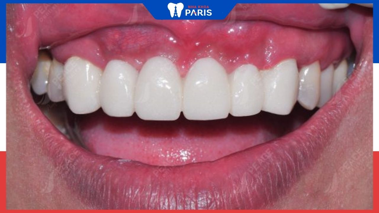 Nên bọc răng sứ loại nào? Điểm tên 2 dòng răng sứ phổ biến