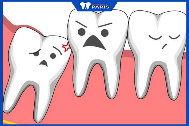 Răng khôn mọc lệch, mọc ngầm cần phải nhổ để phòng biến chứng