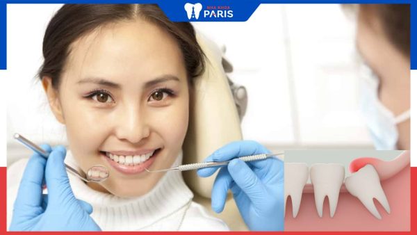 Nhổ răng khôn bao lâu lành? 4 yếu tố ảnh hưởng thời gian hồi phục