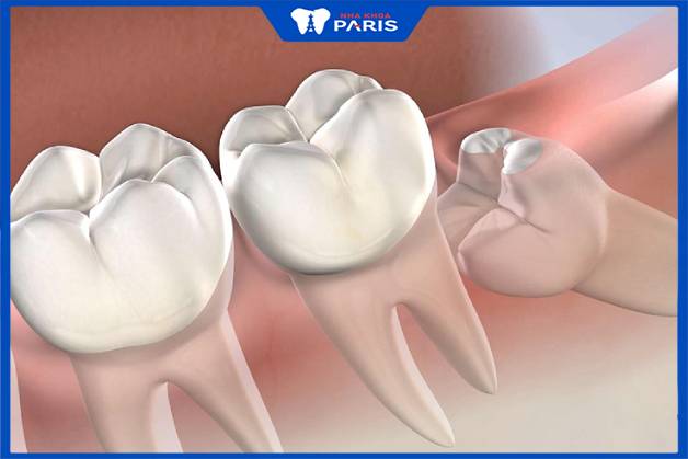 Răng khôn mọc ngầm trong xương hàm làm tăng nguy cơ gãy xương hàm